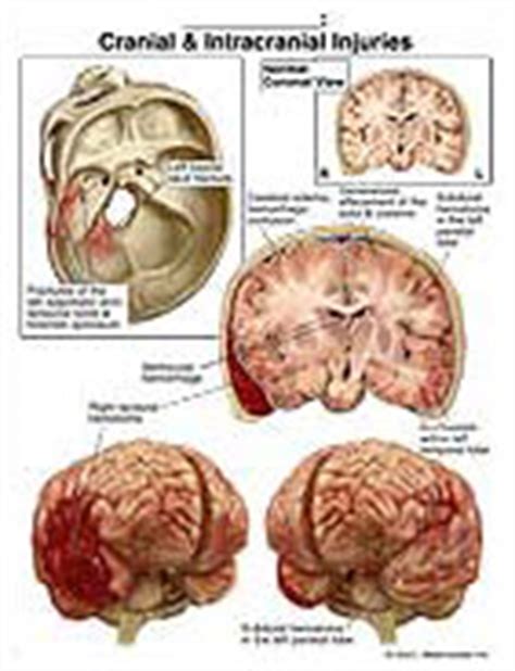 [1] The most common conditions that can be treated via this <b>approach</b> include brain tumors, aneurysms, arterio-venous malformations, subdural empyemas, subdural hematomas, and intracerebral hematomas. . Right frontal craniotomy open approach icd10pcs